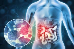 Colon Cancer is on the Rise