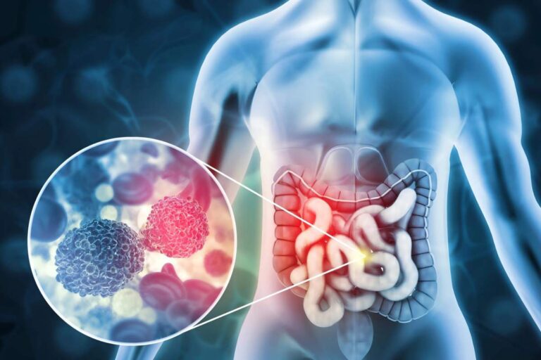 Colon Cancer is on the Rise