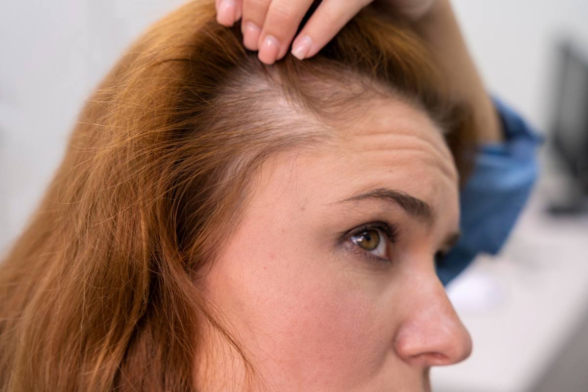 Alopecia