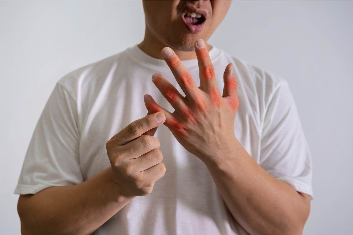 High Uric Acid