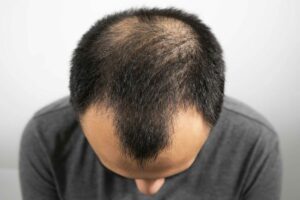 Androgenetic Alopecia