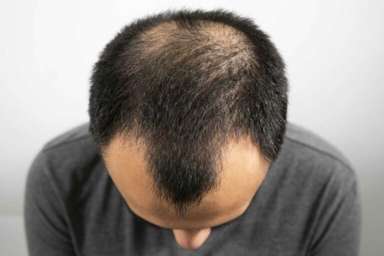 The Biology of Pattern Hair Loss: Inside DHT, Genetics, and Clinical Treatment