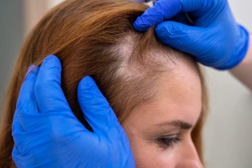 alopecia